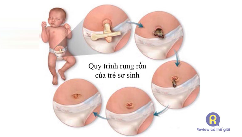 Quy trình rụng rốn của trẻ sơ sinh