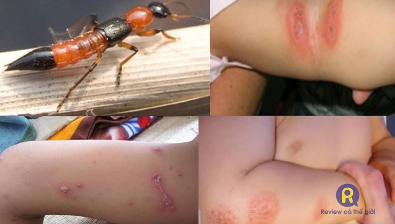 Tình trạng viêm da nghiêm trọng do kiến ba khoang đốt